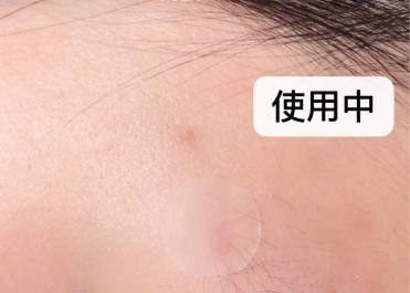 vt痘痘贴成分?可以使痘痘消肿吗? vt痘痘贴成分?可以使痘痘消肿吗?